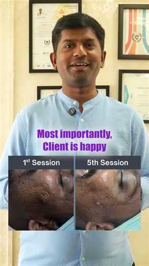 ✨From textured, tanned skin to smoother, clearer results #skincare #skincarechennai