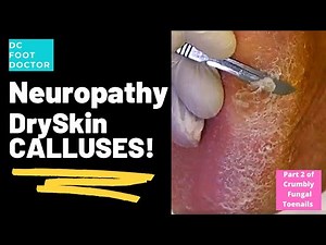 Neuropathy Dry Skin Calluses: Part 2 of Crumbly Fungal Toenails