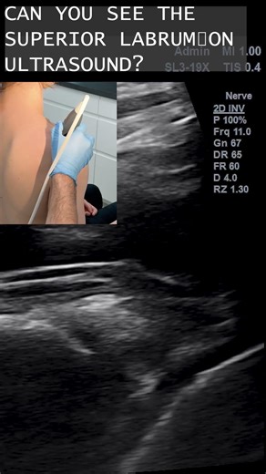 Superior Labrum Ultrasound — How to Visualize It (MSK Technique)