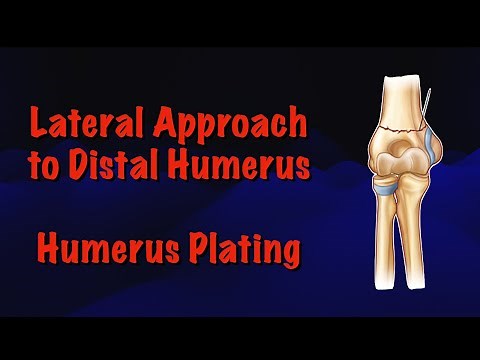 Lateral Approach to Distal Humerus: Humerus Plating Surgical Technique | Dr. Deepak Garg