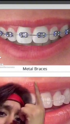 #CapCut she definitely sid NOT want it that way 😅 #headgear #braces #reaction