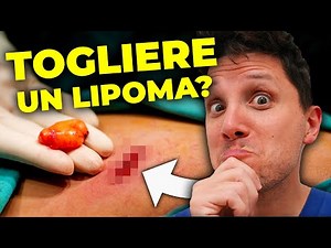 Asportazione Lipoma: Come funziona l'intervento? Dott. Claudio Maestrini