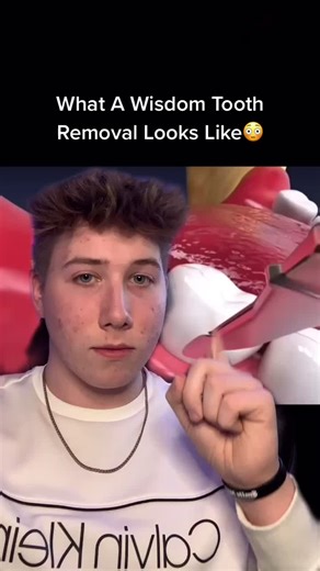 Wisdom Tooth Removal Process Explained