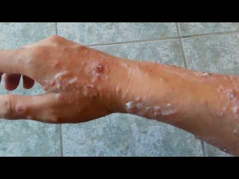 Poison Ivy Rash and Blisters