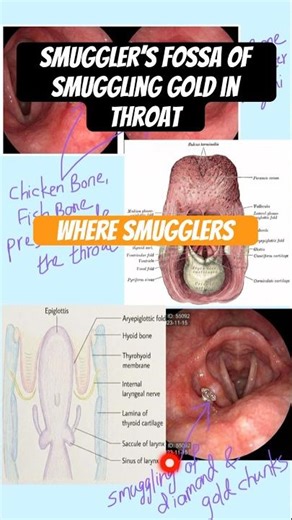 Pyriform/Smuggler’s Fossa in Larynx #neetpg #anatomy #mbbs #medicaleducation