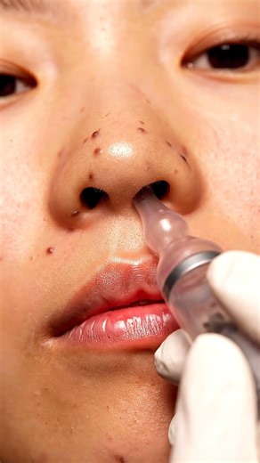 Vacuuming Deep Blackheads Inside the Nose | Extreme Close-Up