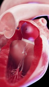💓 Descubre las válvulas esenciales del corazón: Tricúspide y Mitral 💓 Descubre las funciones vitales de las válvulas tricúspide y mitral en el funcionamiento del corazón. Estas válvulas garantizan el flujo sanguíneo adecuado entre las cavidades, donde la tricúspide controla el lado derecho y la mitral el izquierdo. Explora su estructura, función y qué sucede cuando no funcionan correctamente. Ideal para cualquier persona interesada en cardiología o en el cuidado de la salud cardíaca. Música de