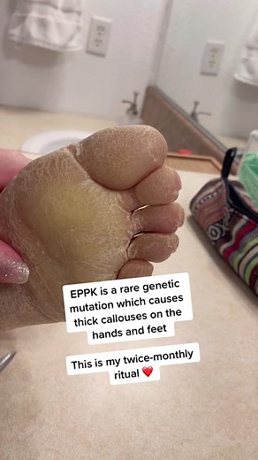 Removing the thick callous on my feet, starting with my toes 😅 #callousremoval #callousedfeet #skinconditions #rarediseaseawareness
