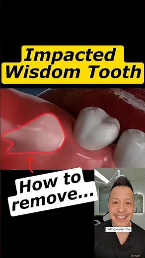 How Do Dentists Take Out Impacted Wisdom Teeth? #dentallan #dentist #shorts