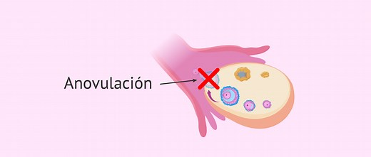 ¿Qué es la anovulación? - Causas, síntomas y tratamiento