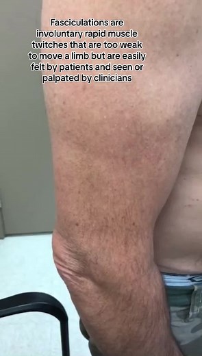 Understanding Fasciculations: Causes and Symptoms Explained