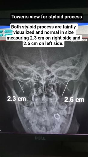 NORMAL STYLOD PROCESS
