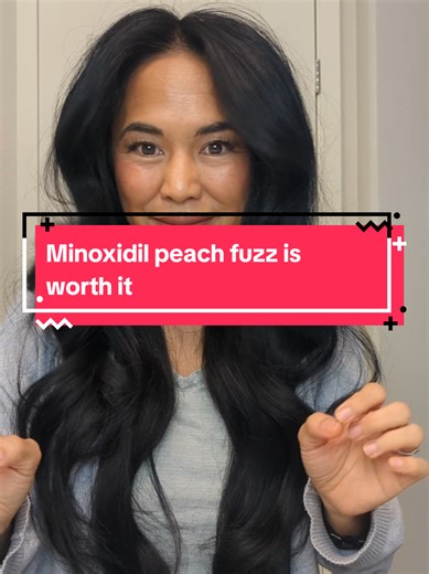 Getting peach fuzz can be one of the most surprising parts of the Minoxidil journey, but it is actually a great sign of progress. It means your follicles are becoming active again and the treatment is reaching the areas where you want to see new growth. #hairgrowthtips #minoxidil #minoxidilresult #minoxidilbeforeandafter #hairgrowth