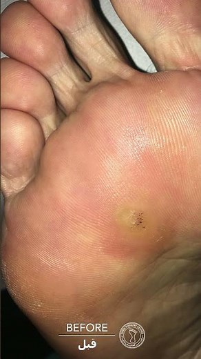 Dermojet for Stubborn Plantar Warts: The Deep Treatment That Actually Works