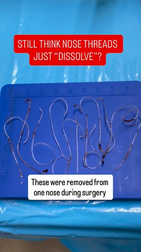 Still think nose threads just “dissolve”? These were removed from one nose during surgery. Thread-lift rhinoplasty may look simple on the surface, but the threads — especially the barbed types — can create problems beneath the skin. Those tiny hooks are designed to anchor into the soft tissue, and the body forms scar tissue around them. This can lead to: • asymmetric fibrosis, which can pull the soft tissue off-centre • tethering from scar tissue, reducing the natural movement and elasticity of 