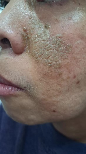 Understanding Dermatosis Neglecta: Causes and Treatment