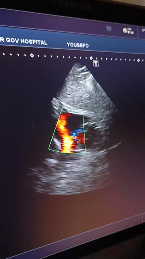 9.1K views · 40 reactions | ? IS IT PFO OR SMALL ASD...