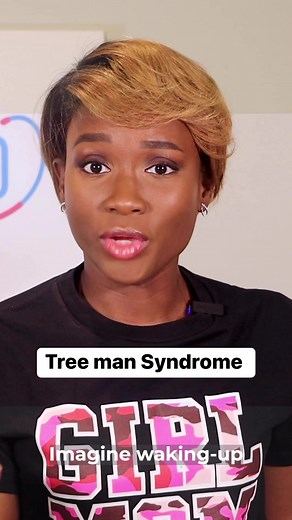 1.1K views | Epidermodysplasia verruciformis (EV) is sometimes called “tree-man disease” or “human tree disease.” It’s a very rare syndrome that causes bark-like lesions to grow on your skin. The lesions are disfiguring and can grow so large that they become disabling.‌ This sounds crazy doesn’t it? Have you heard of Tree man syndrome before? Let’s discuss in the comments #treemansyndrome #checkwithdoctoro | Check with Doctor O | Facebook