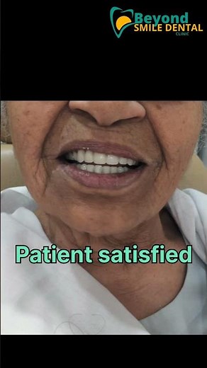 Full mouth case with multiple extractions followed by complete denture. #dentist #dentalclinic