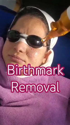 Birthmark Removal with Pico Laser | Nevus removal | Pico Laser