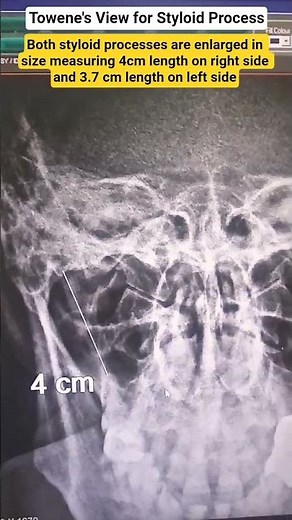 Styloid process#Towen's view for styloid process #xray #enlarged#Xray with report by MD radiologist