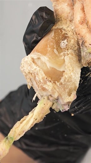 ingrown toenail removal satisfying videos with swollen | CTH B2