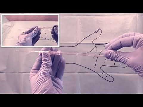 Cateter arterial radial