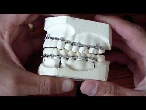 Wiring Fractured Jaw - Erich Arch Bars