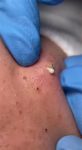 Deep Pore Cleansing Close-Up | Blackhead & Whitehead Extraction Session