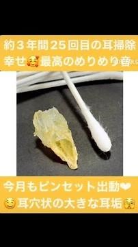 126👂#耳掃除 #耳かき #耳そうじ 【まるでサナギ！？穴のカタチの巨大耳垢】