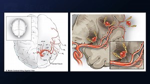#307: Treatment of a Ruptured Mycotic Middle Cerebral Artery Aneurysm with Excision and Reanastomosis - Aneurysm - Seven Series Collection