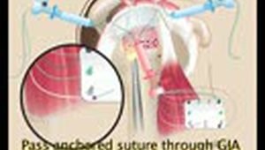 Rotator Cuff Reconstruction using a Acellular Human Dermal Allograft