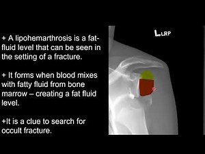 Shoulder X-Ray: Shoulder Dislocation and Complications