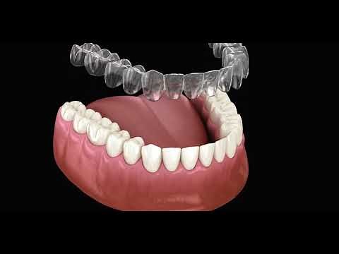 Les Aligneurs Invisibles