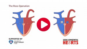 12 reactions |  The latest in our CHD animations, funded #becauseofyou, is The Ross Procedure. These videos are useful for patients and their families to further understand their diagnoses as well as helping to explain a condition to others. You can watch all heart animations funded so far here: www.youtube.com/playlist?list=PLEHWAMNr-4U5h_K1_Yr2nBSmYF4YfdGiJ | Children's Heart Surgery Fund | Facebook