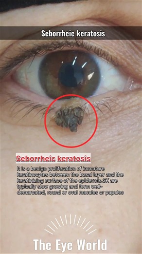 The Eye World™:Seborrheic keratosis #eyes #ophthalmology #eyelids #youtubeshorts