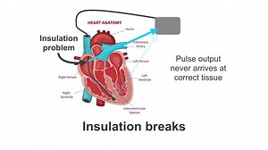 In today’s teaching video, British pacemaker expert Kristian Webb will explain what failure to capture is, why it’s important that you know about it, possible causes and what to do about it. Find out more in our Pacemaker Essentials course: https://bit.ly/2W0b3gP | Medmastery