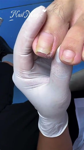 So painful you can’t even touch it 😰 | Vinh nails #nailpros #nails #shiningnails #footnailcare