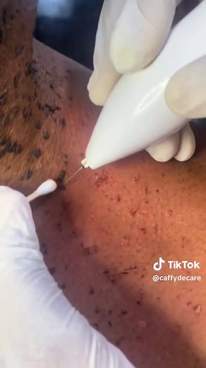 #skintagremoval #skintag #fypp #fyp #explore