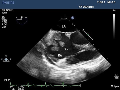 Primary malignant cardiac tumor(right atrial angiosarcoma)