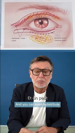 Lower Blepharoplasty Explained 🎥