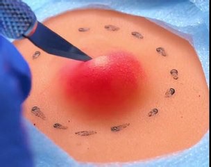 Big Boil, Clean Removal