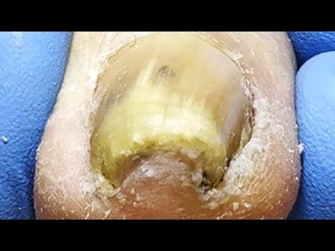 Swollen Ingrown Toenails, Cut Off Large Pieces Of Ingrown Toenails【Xue Yidao】