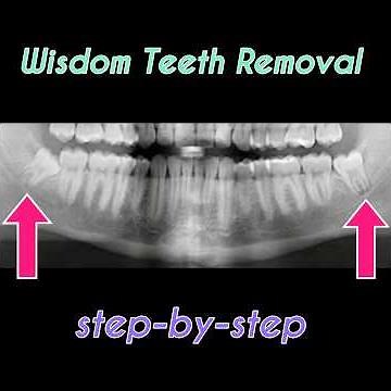 Lower Wisdom Teeth Extractions
