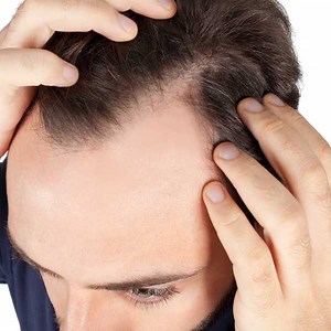 PRP Hair Loss Treatment in Dublin, Ireland - VISTA CLINIC