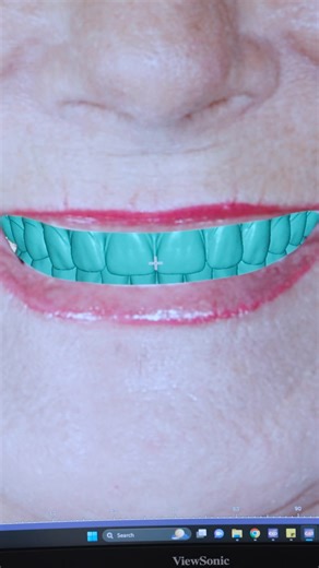 Do you have missing or failing teeth? At Doctors Implants, we know the pain runs deeper than just your mouth. It affects how you eat, speak, and show up in life. That’s why we offer minimally invasive Full Mouth Dental Implants—engineered to look, feel, and function just like natural teeth. ✅ Less pain. ✅ Faster recovery. ✅ One team under one roof. Our doctors have placed thousands of implants using advanced techniques for long-lasting, life-changing results. The outcome? A smile so natural… no 