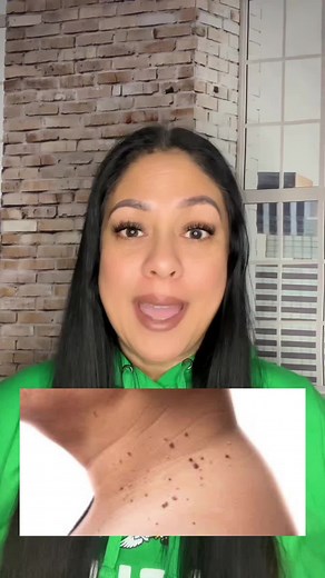 Understanding Skin Tags, Warts, and Moles: Causes and Natural Remedies