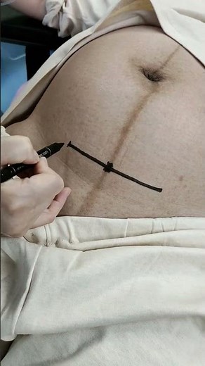 剖宫产切口有多长画条线比划一下就知道👇🏻#接一切