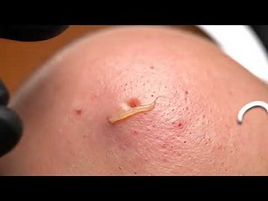 Gross BUT Satisfying: Blackhead Removal That Will Make You Say WOW 🤢