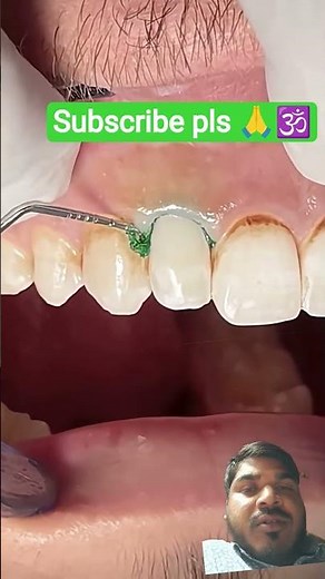 Class V composite restoration usingretraction cord #dentist